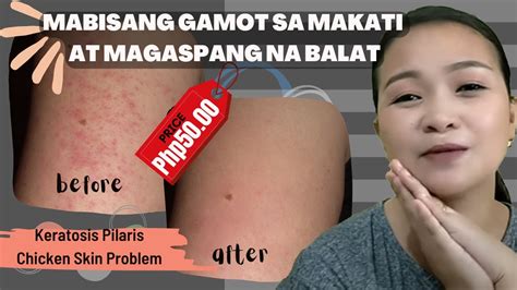 gamot para sa dry na balat
